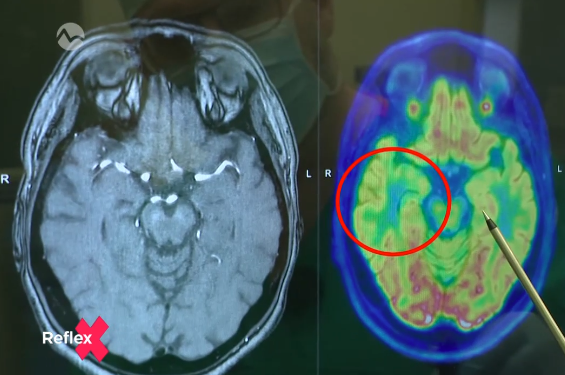 Reportáž o operáciách mozgu pri epilepsii na našom pracovisku